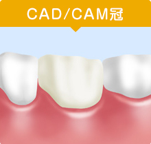 CAD/CAM冠