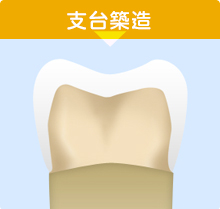 支台築造