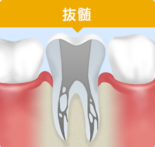 抜髄