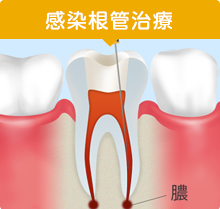 感染根管治療