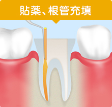 貼薬、根管充填