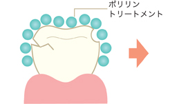 歯周病で歯を失いたくない方!