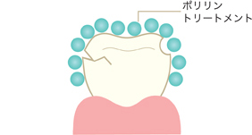 歯周病で歯を失いたくない方!