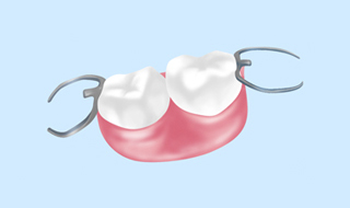 部分床義歯